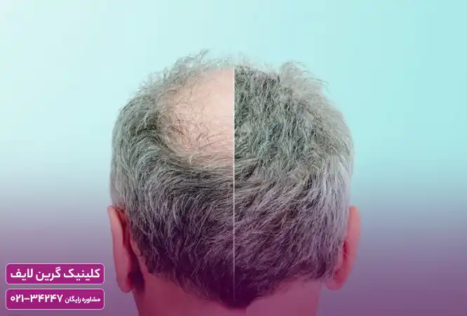 رشد مجدد موی سر با کلاه لیزری
