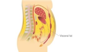 چربی احشایی، لاغری با دستگاه و لاغری چربی احشایی