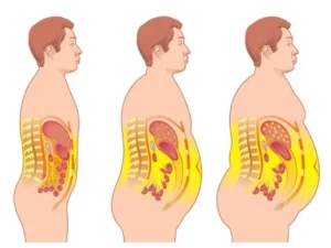 چربی احشایی لاغری چربی احشایی